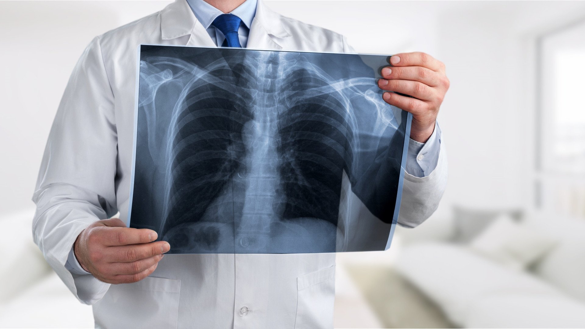 Arzt mit Röntgenbild der Lunge bei Erkrankung der unteren Atemwege